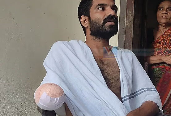 മീനിന്റെ കുത്തേറ്റ് അണുബാധ; തലശേരിയിലെ യുവാവിന്റെ കൈപ്പത്തി മുറിച്ചുമാറ്റി