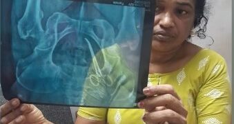 അഞ്ച് വര്‍ഷമായി വേദന; യുവതിയുടെ വയറ്റില്‍  കത്രിക കണ്ടെത്തി