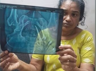 അഞ്ച് വര്‍ഷമായി വേദന; യുവതിയുടെ വയറ്റില്‍  കത്രിക കണ്ടെത്തി
